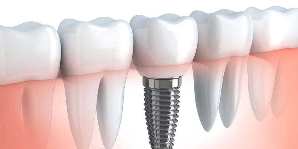 Dental Implants Kitchener