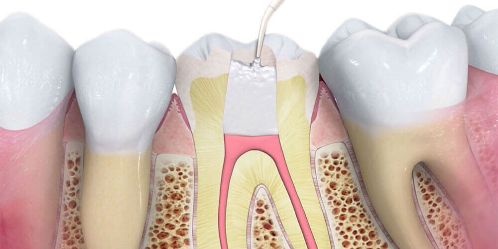 Root Canal Treatment Kitchener
